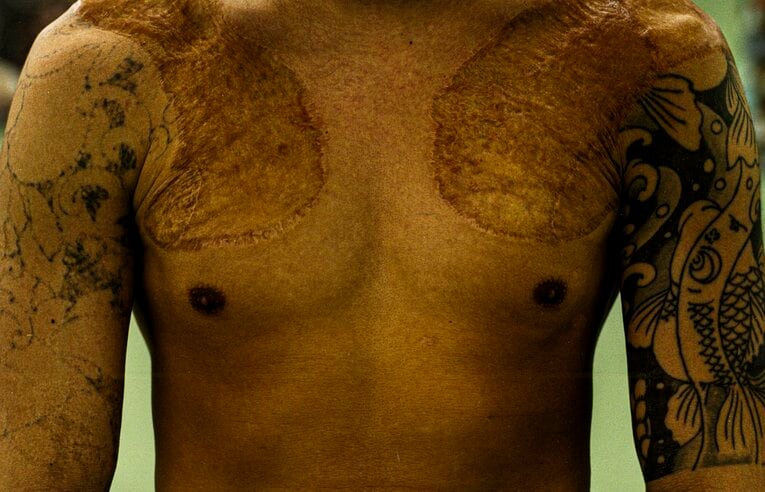 宏成はプロのリングに上がるため、皮膚を移植して入れ墨を消した　©︎Kenji Hayashi