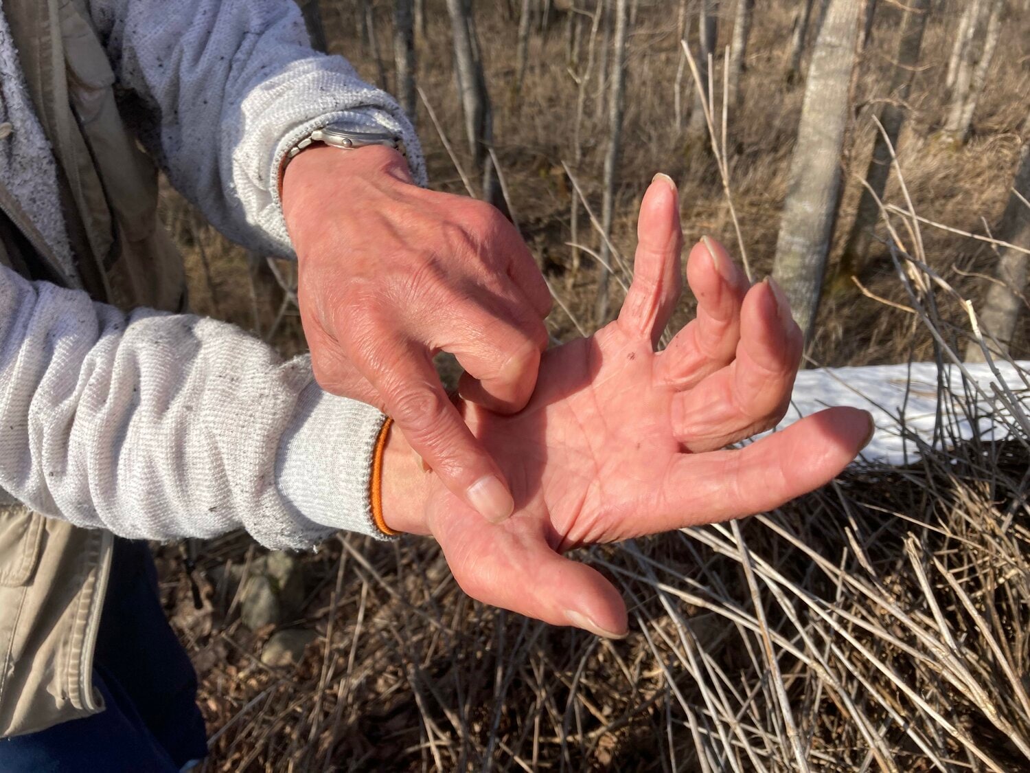 山田さんの右手。指さした部分の凹みがクマの歯痕 撮影:風来堂