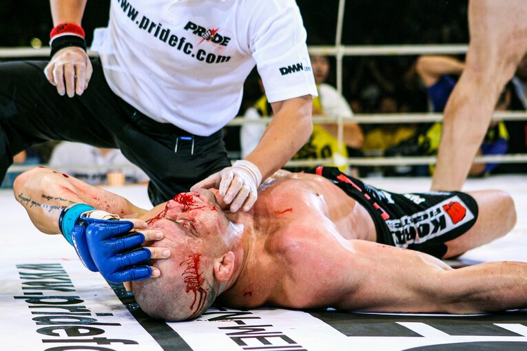 シウバはハイキックがヒットした側頭部に裂傷を負っていた　©Susumu Nagao