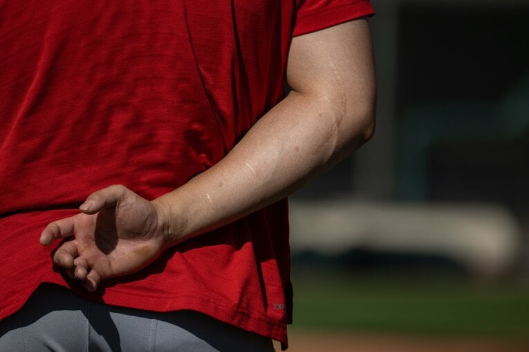 手術跡が残る右腕　©Nanae Suzuki