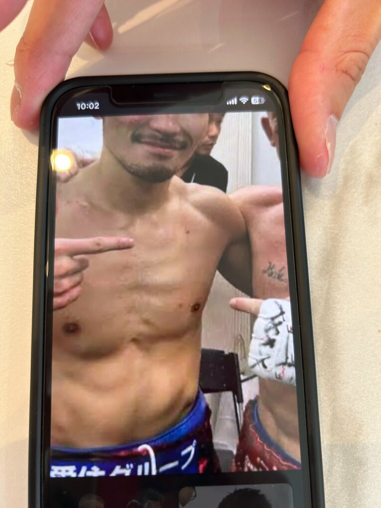 ドヘニーと戦った直後、噛みつかれた跡が見える写真を見せてくれた岩佐　©Masayuki Sugizono