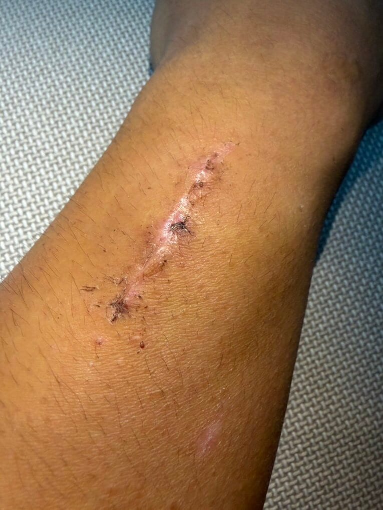 腕上がりを緩和するための、佐々木歩夢の生々しい手術後（本人提供）