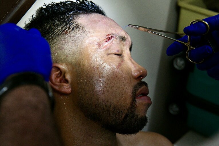 試合後、麻酔なしで傷口を縫合する内藤律樹　©Kokou Sekine