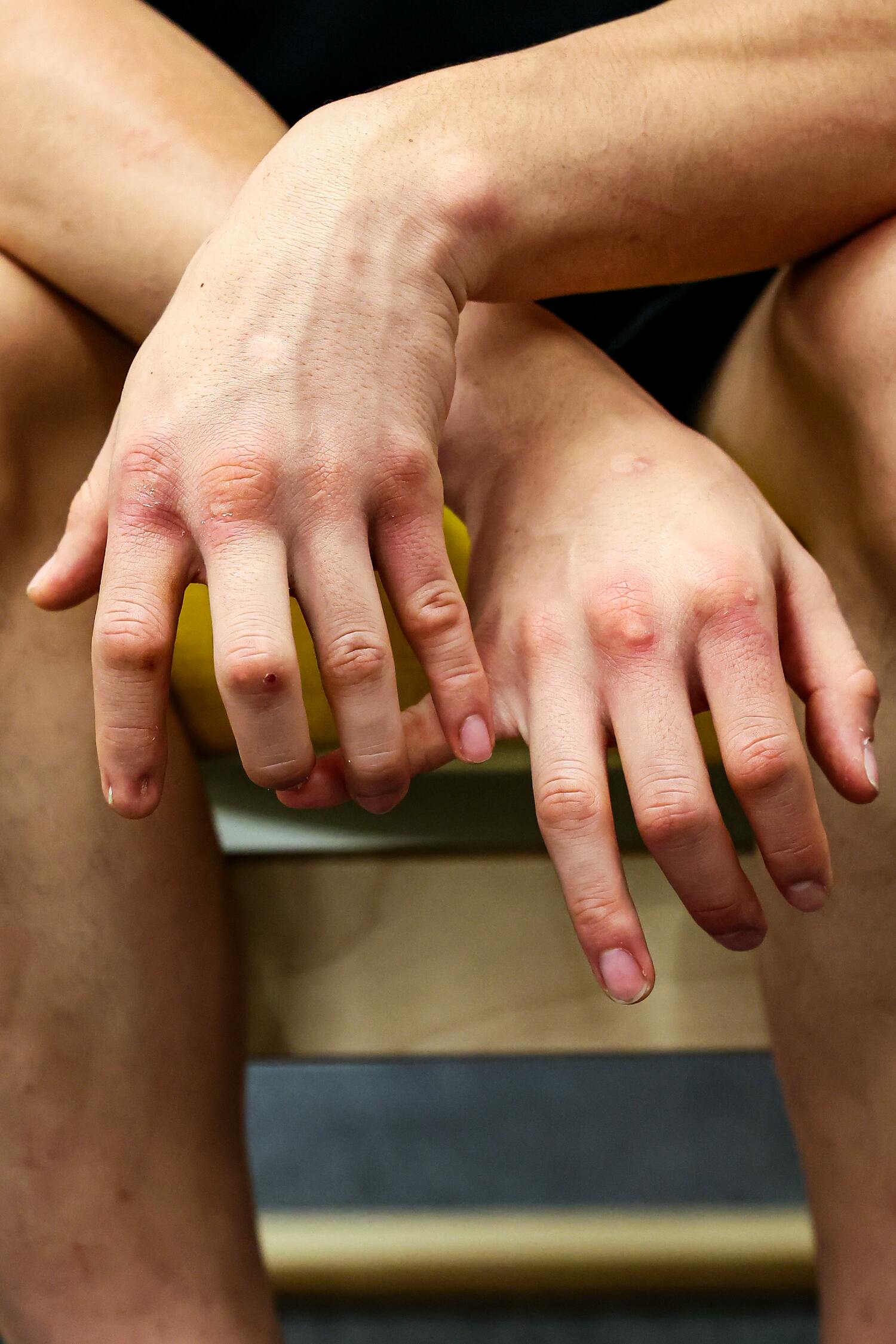 傷だらけの拳がトレーニングの充実ぶりを物語る　©Susumu Nagao