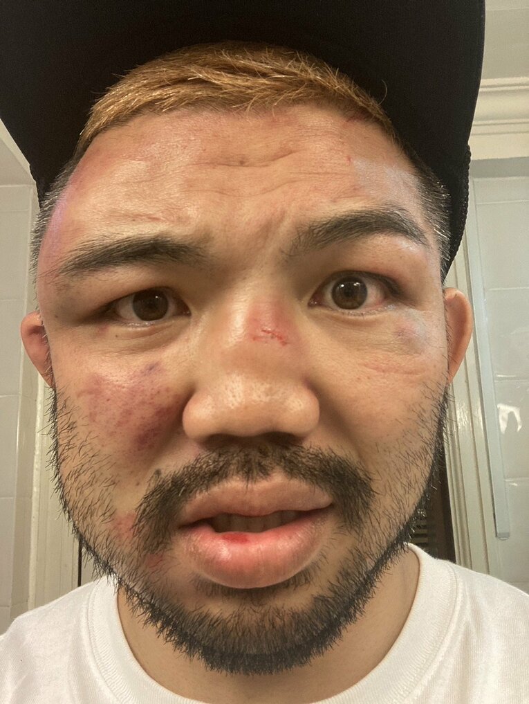 顔はこのように腫れ上がる。これでも前回より腫れてないとのこと　写真は本人提供