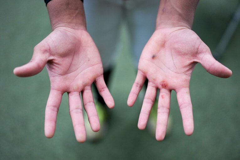 バットを振ってきたことがわかる潰れたマメ　©︎Akito Iwamoto