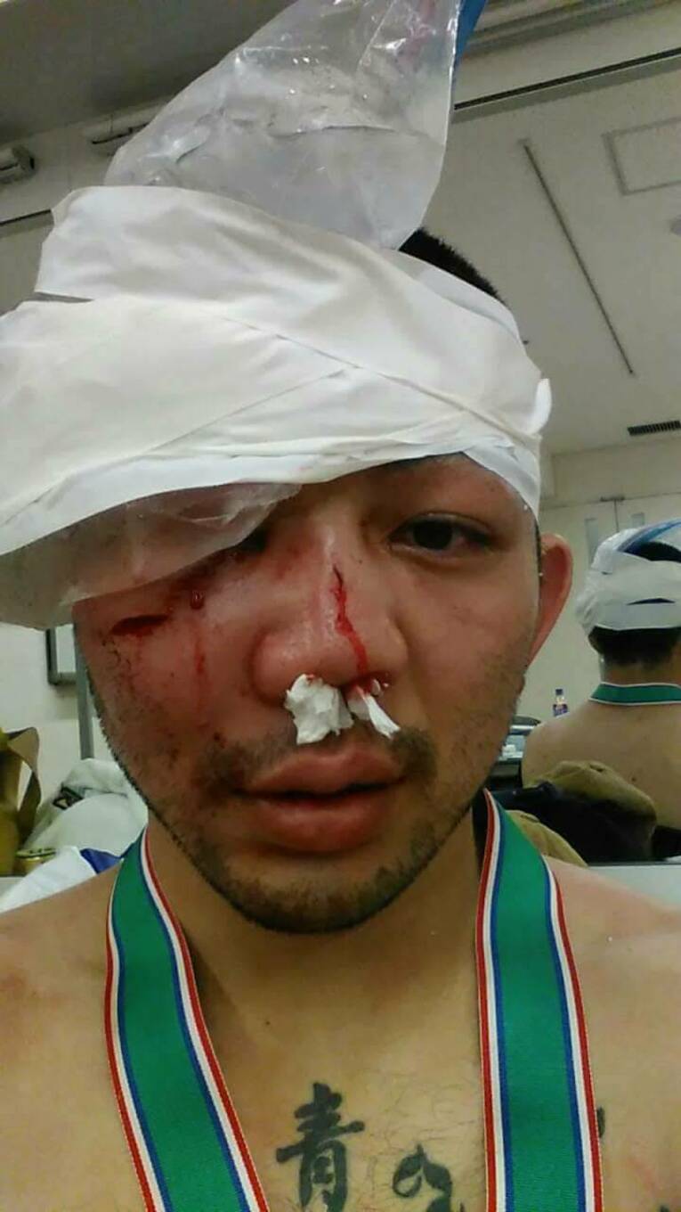 試合で顔を切られた渡慶次（本人提供）