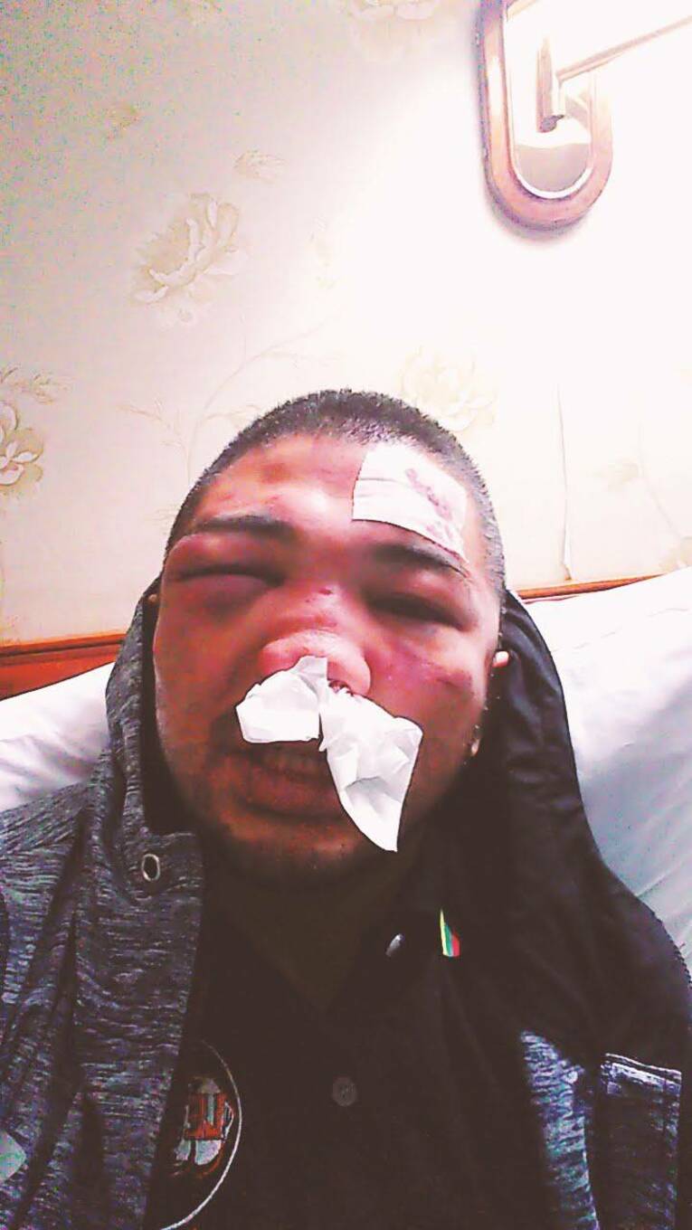 デビュー戦でボコボコにされた渡慶次の顔（本人提供）