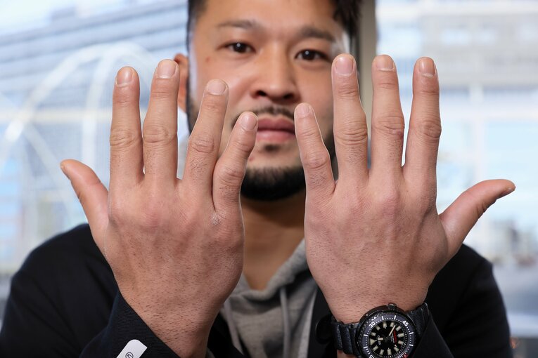 「日常生活に支障はない」としながらも、当時負傷した右手小指は今も歪んだまま　©︎Shigeki Yamamoto