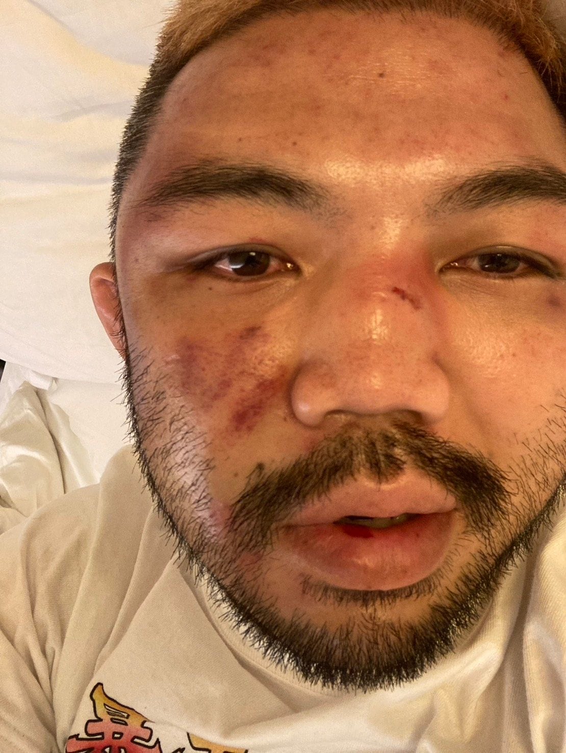 腫れてないと評された顔、痛みが強く1日中ホテルで過ごした　写真は本人提供