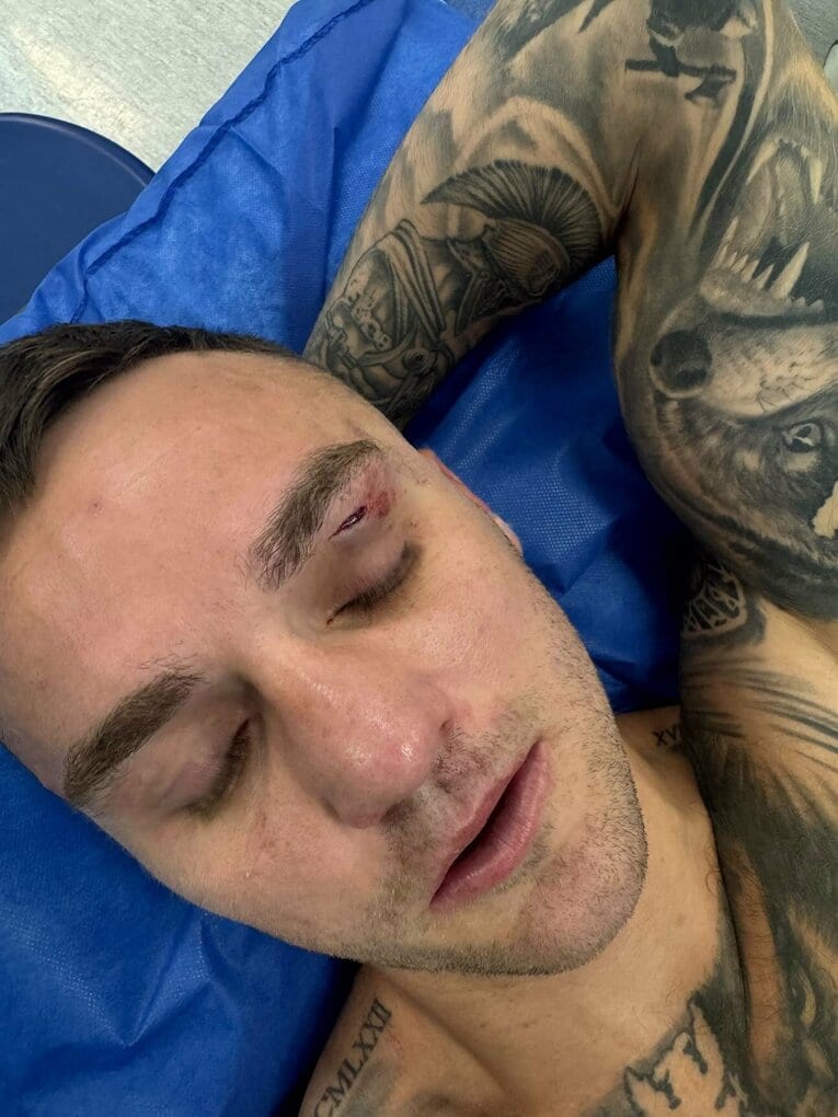 昨年12月、左目上を負傷したサム・グッドマン（オーストラリアのジャーナリスト、ベン・デイモン氏のXより）