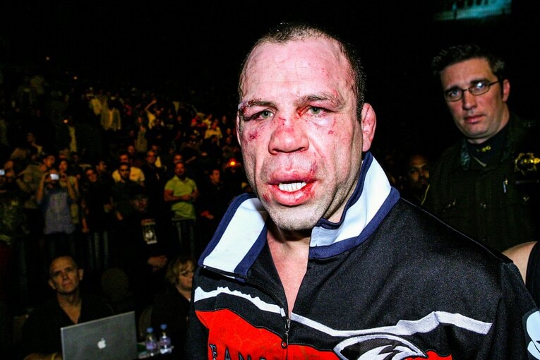 チャック・リデルに敗れたシウバ。試合後の顔は傷だらけだった　©Susumu Nagao