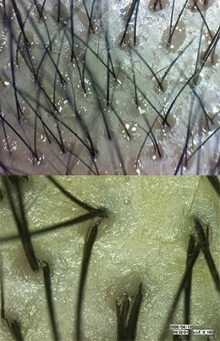 スカルプケアを怠った頭皮のアップ。表面はベタつき、毛穴には皮脂がぎっしり！　これらが嫌な臭い、抜け毛、細毛の要因に繋がる。 