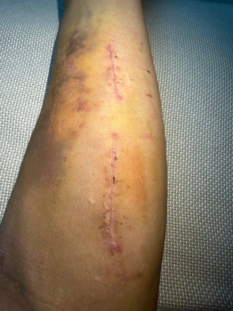 腕上がりを緩和するための、佐々木歩夢の生々しい手術後（本人提供）