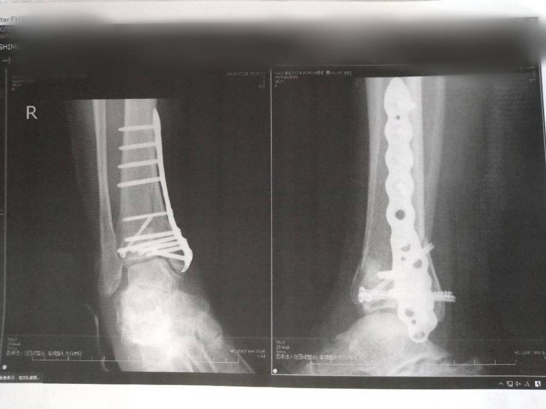 現在KAORUの身体に入っているプレートやスクリューの画像。ラストは入れたままで試合をする　©本人提供