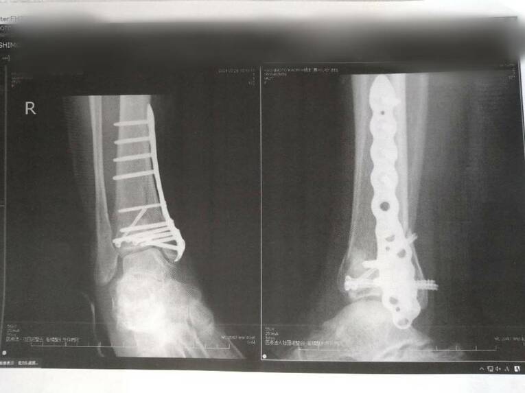 現在KAORUの身体に入っているプレートやスクリューの画像。ラストは入れたままで試合をする　©本人提供