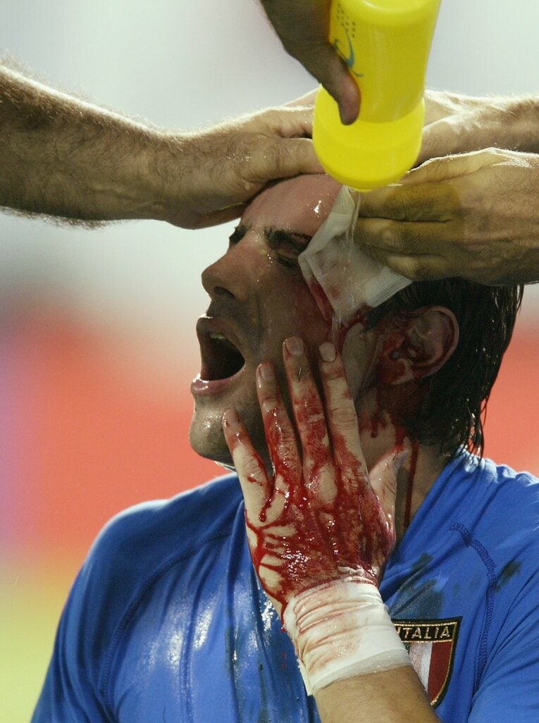 顔面から出血したフランチェスコ・ココ　©Getty Images