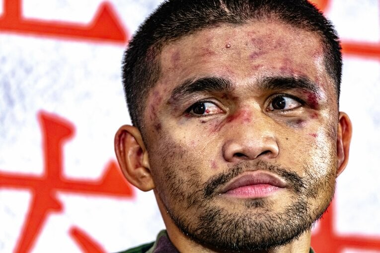 傷だらけの顔で試合後の会見に出席したタパレス　©Takuya Sugiyama